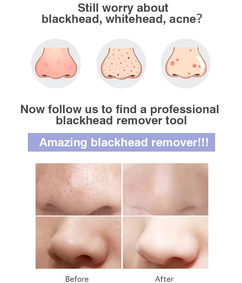 home skincare nose pore cleaning device use
