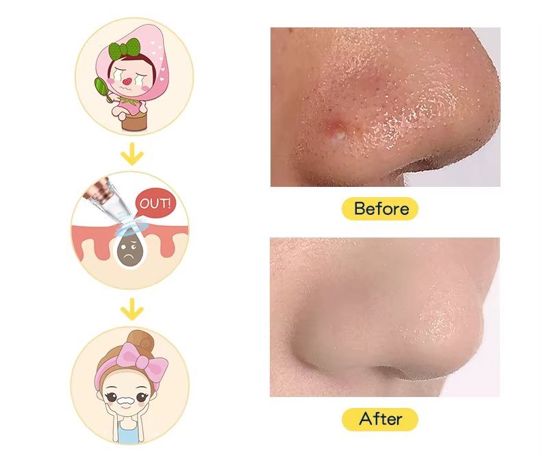 Nose Face Deep Pore Cleaner Blackhead Remover Tool