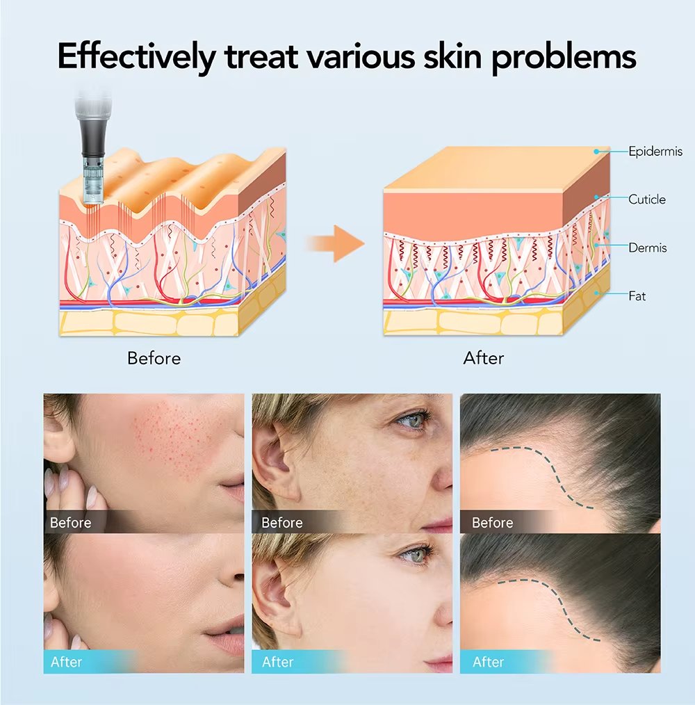 Microneedle Pen Face Care Tool Beauty Device for Acne Treatment Tighten Skin