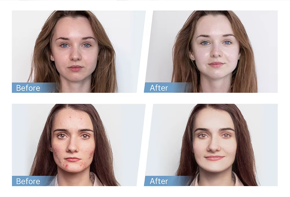 Skin Auto EMS Electroporation Needle System Microneedling Derma Dr Pen